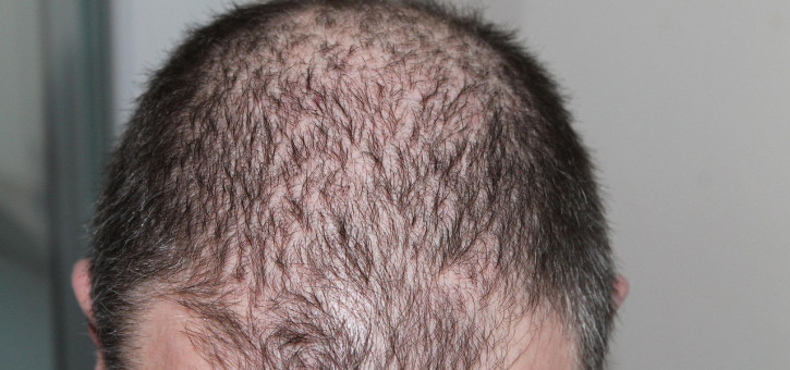 Beitragsbild zu Haartransplantation in der Türkei: Warum Smile Hair Clinic Ihre beste Wahl ist