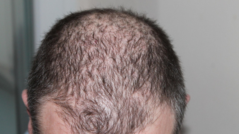 Beitragsbild zu Haartransplantation in der Türkei: Warum Smile Hair Clinic Ihre beste Wahl ist